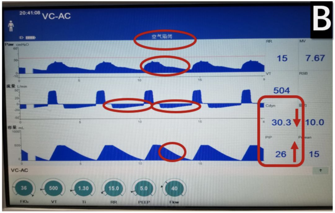 新型冠状病毒重症病例的治疗原则,新型冠状病毒危重治疗原则是什么