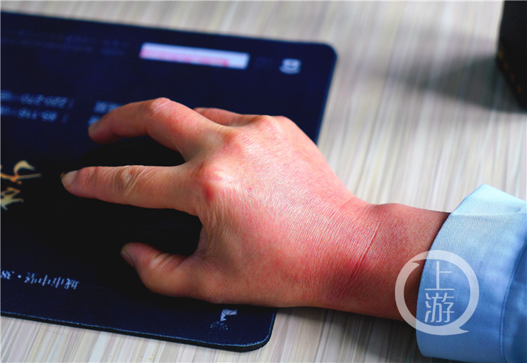 这双长满红疹的手，是“疫”线最美的双手