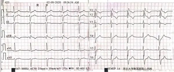 一度房室传导阻滞是怎么得的,三度房室传导阻滞最简单看法