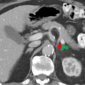 在线心内会诊室丨原醛治疗,“柳暗花明又一村”