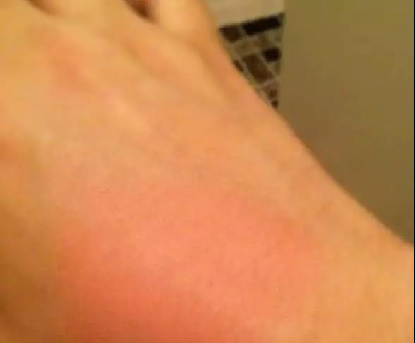 儿童开水烫伤急救处理,被开水烫伤怎么办最快最有效