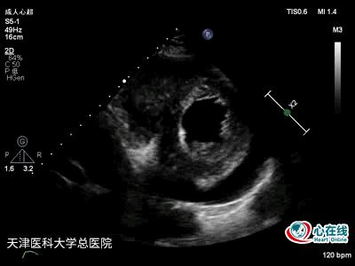超声心动图发现赘生物,超声心动图检查结果疑似赘生物