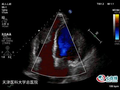 超声心动图发现赘生物,超声心动图检查结果疑似赘生物