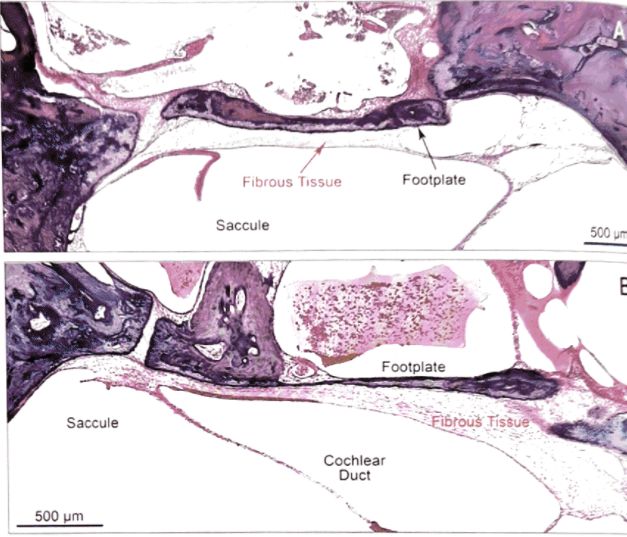 22张图，细说梅尼埃病的组织病理学特点丨“晕”筹帷幄