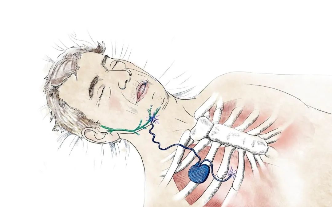 睡眠呼吸暂停的临床意义,肥胖睡眠呼吸暂停综合征