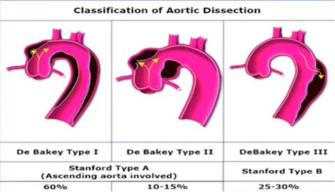 主动脉夹层真假腔鉴别超声示意图,主动脉夹层诊断中国专家共识