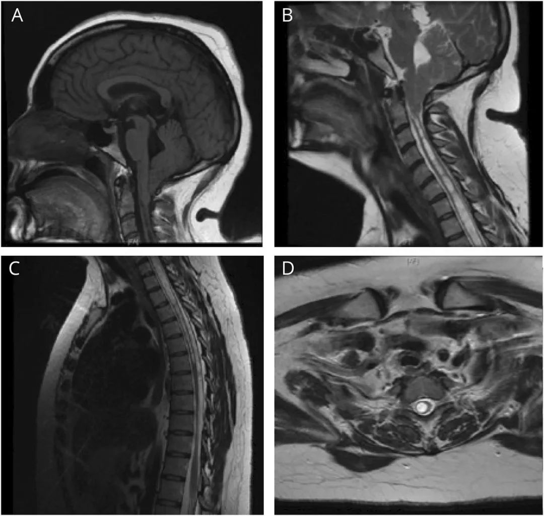 为什么病人不能脱离呼吸机,病人为什么难以拔掉呼吸机