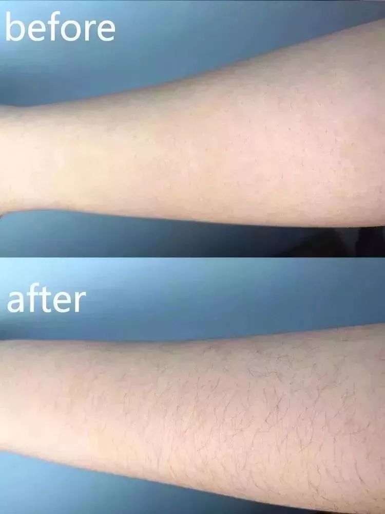 有没有一款真正永久脱毛的脱毛膏,你还在用剃须刀刮胡子吗