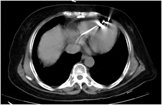 心电图显示心室起搏,心电图电极v4位置