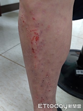 皮肤痒红疙瘩湿疹怎么治疗,湿疹红斑发痒怎么消除