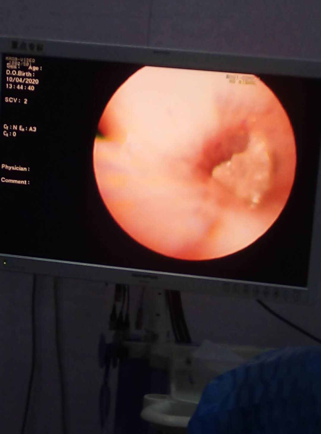 婴儿吃苹果快呛到肺里的症状,小宝宝吃苹果卡住后一直呛咳