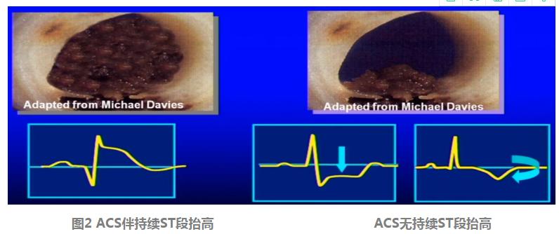 胸痛急救知识点,急性胸痛的诊断思路