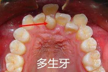换牙出现双排牙不齐怎么办,孩子换牙齿长双排牙怎么办