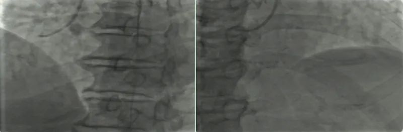病人突发心肌梗死医生抢救视频,冠心病人抢救