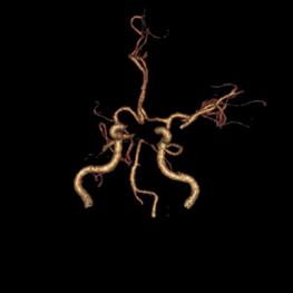 左侧大脑后动脉开窗畸形图片,脑部基底动脉开窗畸形如何治疗