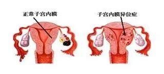 子宫内膜异位最好的治疗方法,子宫腺肌症女性疼痛