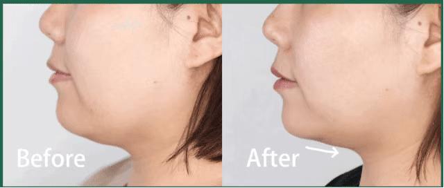 推广一个月没有任何效果,美容院脸部抗衰提拉紧致手法