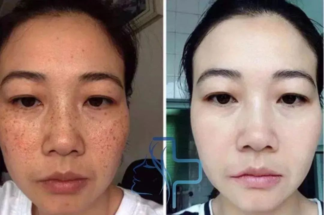 长期补充胶原蛋白的人怎么样了,长期喝胶原蛋白的人最后怎么样了