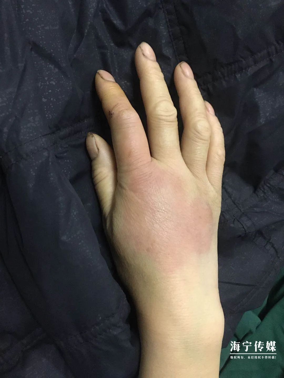 十大毒虫咬人后的症状,十大毒虫咬人了怎么办