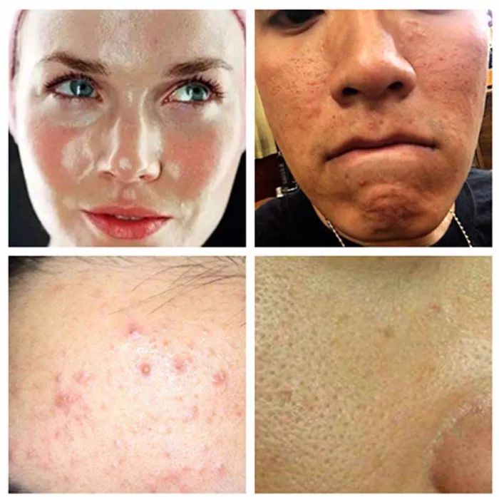 用什么洗脸抑制螨虫生长,用什么洗脸可以抑制螨虫生长