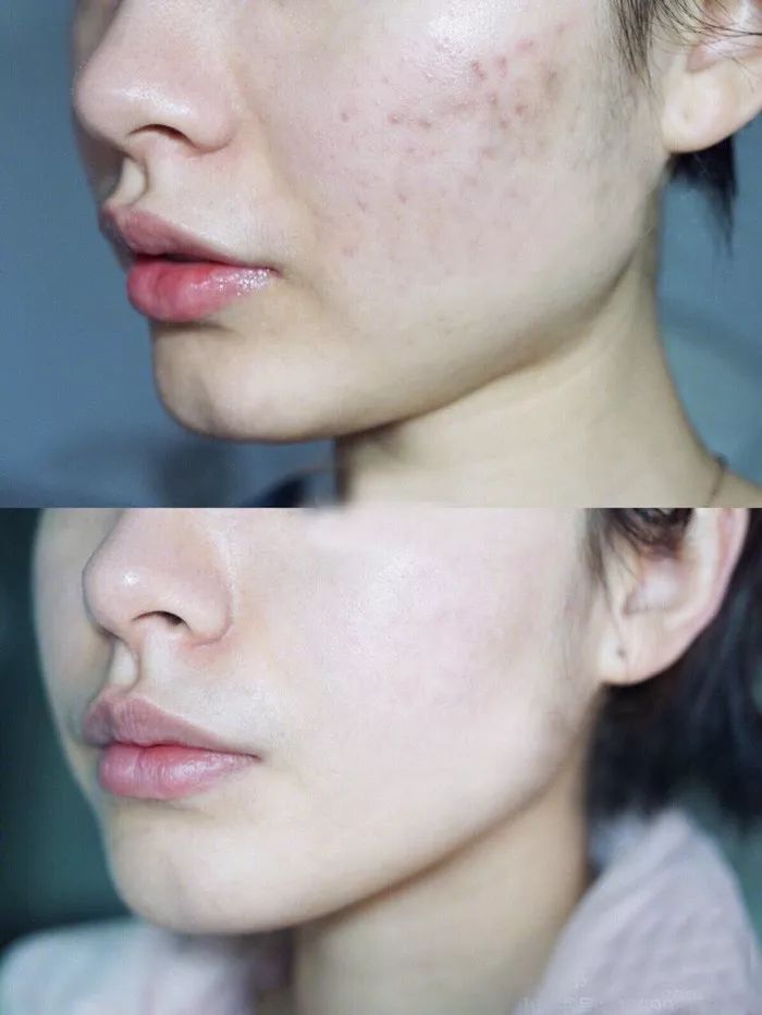 用什么洗脸抑制螨虫生长,用什么洗脸可以抑制螨虫生长