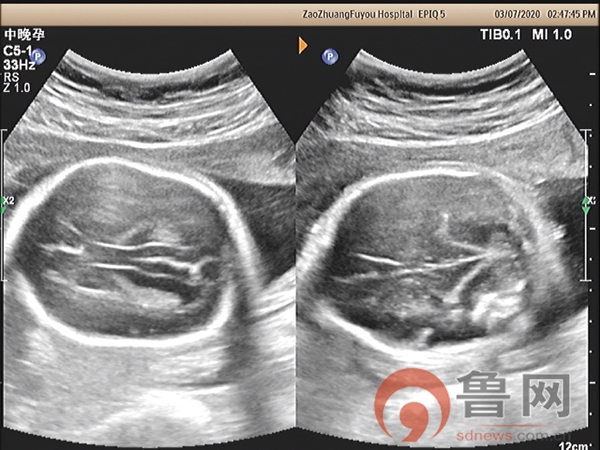 枣庄市妇幼保健院超声科诊断出一例胎儿开放性脊柱裂
