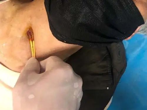 南陵高龄老人长了一个包块很痛苦，他们“一针”解忧