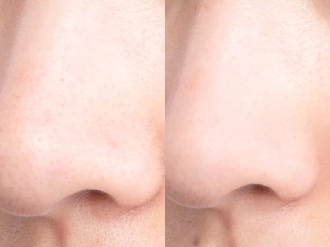 冬天干肌肤补水面膜,女生冬天脸干燥起皮用什么面膜