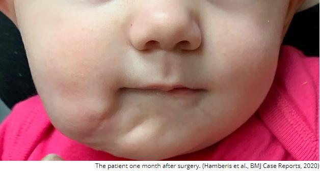 七个月婴儿老张嘴怎么回事,一个婴儿有两张嘴