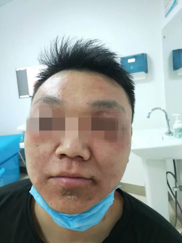 小伙随手捏死一只虫，一觉醒来满脸脓包！夏天到了，一定要当心它