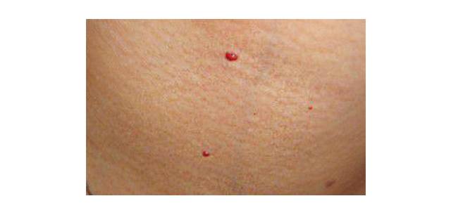 【注意】千万别大意！身上有这种小红痣，很可能是大病的预警信号…