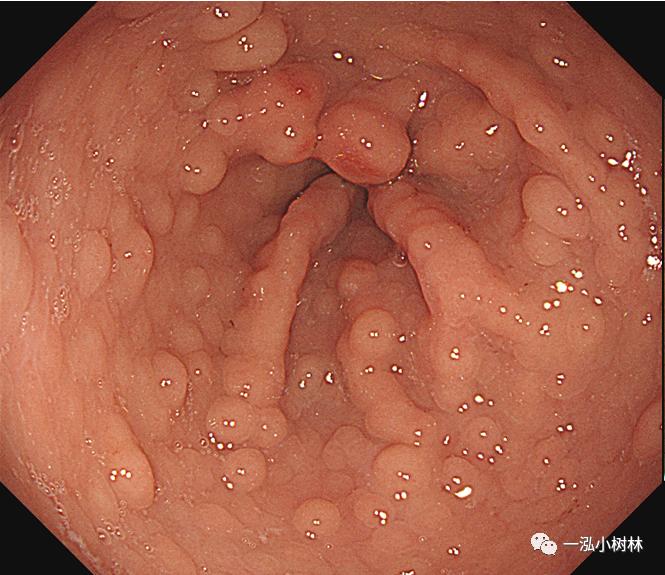 肠上皮化生做什么检查,肠化生内镜看得出来吗
