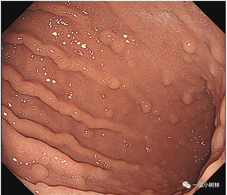 肠上皮化生做什么检查,肠化生内镜看得出来吗