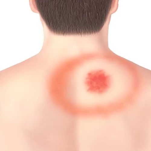 虫子爬到身体里,虫子爬到后背皮肤里面去了