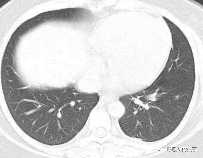 五花八门的发热之一—药物热（1）