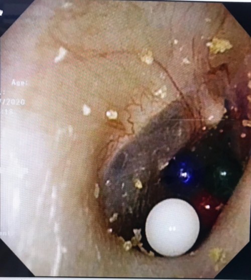 小朋友把异物放入耳朵,儿童把异物塞进耳朵