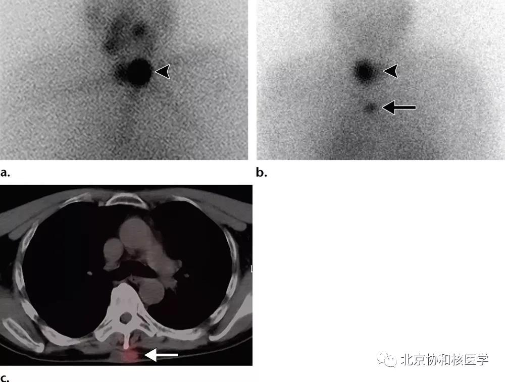 碘扫描最坏的结果,放射性核素扫描可以鉴别诊断吗