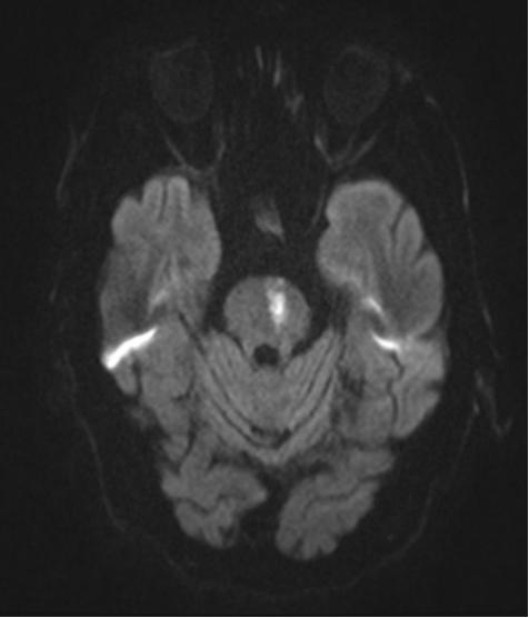 「病例实战」不安腿综合征的诊断策略
