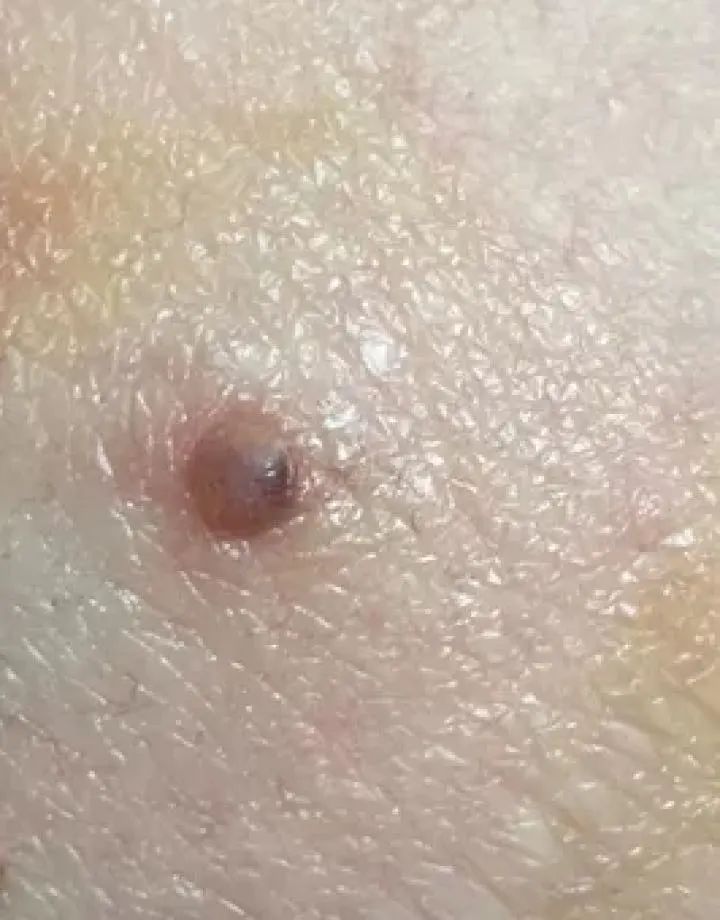 黑痣癌变的10个征兆,黑痣癌变从发病到去世不到两个月