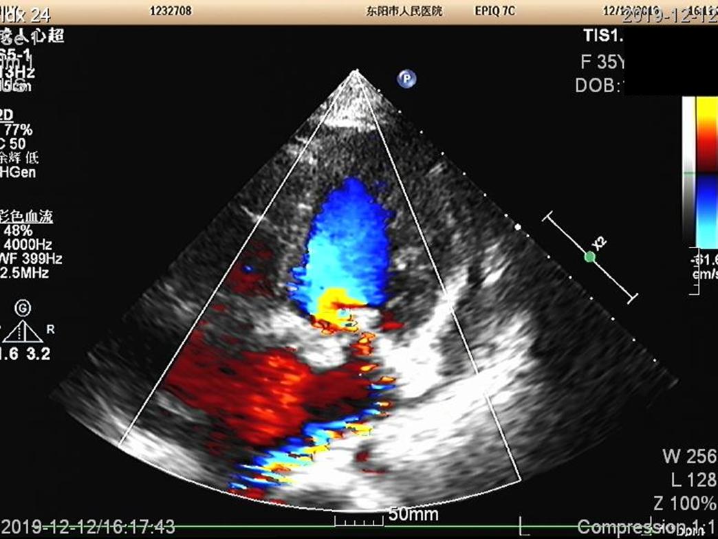 快看！心脏“漏了个洞”，人竟然还活着……