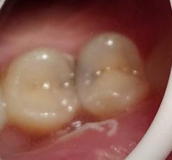 邻面龋能直接磨掉吗,邻面龋多久会烂到牙神经