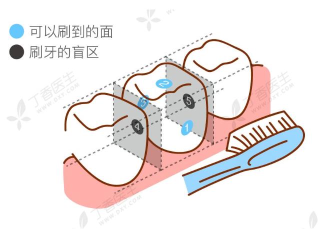 邻面龋能直接磨掉吗,邻面龋多久会烂到牙神经