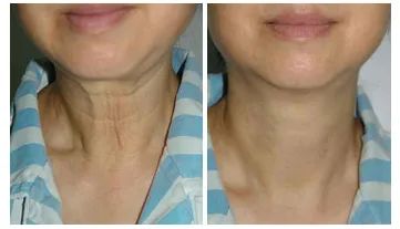 女人脖子有颈纹和年龄有关吗,一条颈纹代表二十岁