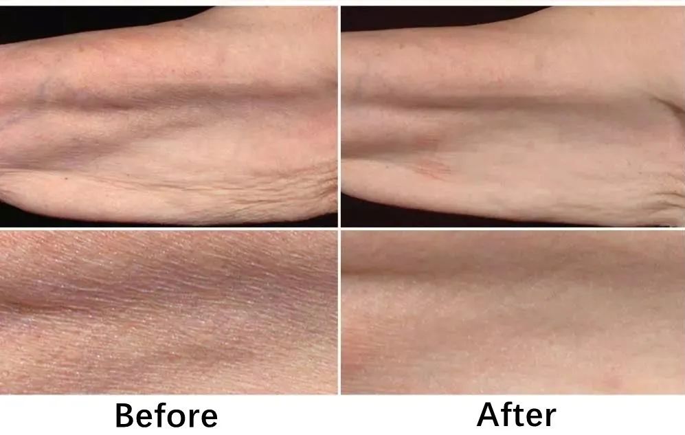 女人脖子有颈纹和年龄有关吗,一条颈纹代表二十岁