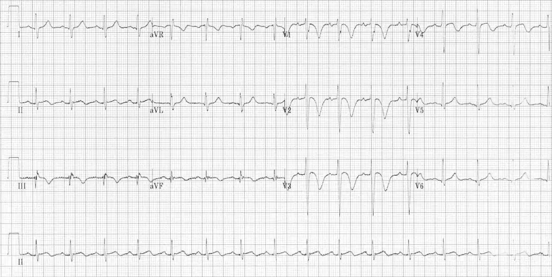 肺栓塞心电图表现是什么,肺栓塞的心电图改变