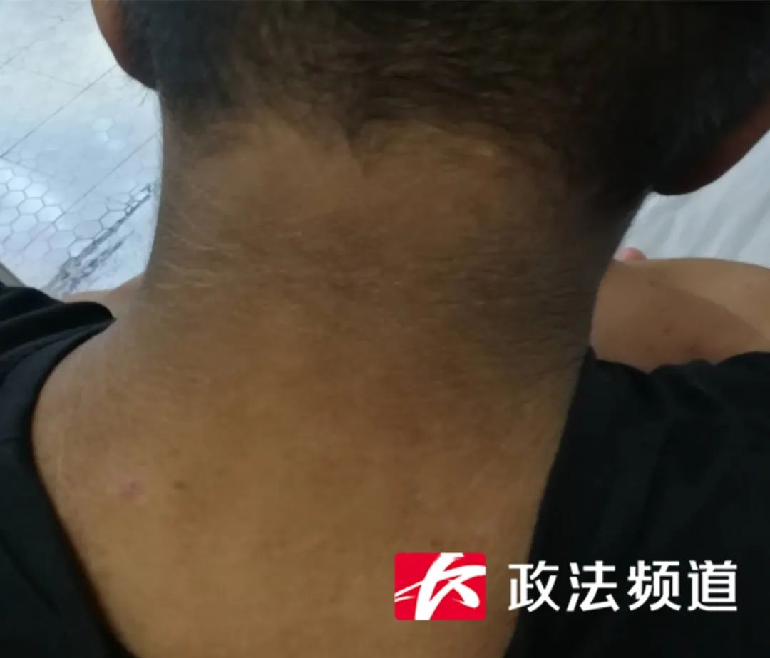 男孩14岁皮肤有黑斑是怎么回事,13岁的男孩皮肤越来越黑怎么回事