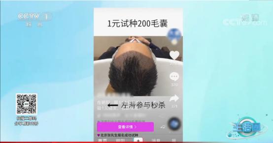 揭秘植发行业内幕,脱发去植发真的靠谱吗