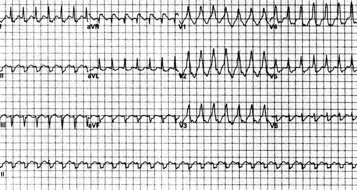 室速属于重大疾病吗,室速的相关资料