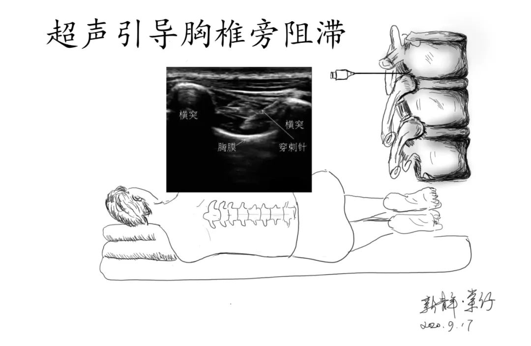 超声引导下的胸椎旁阻滞视频,超声引导下胸椎旁阻滞综述