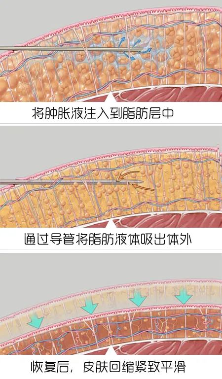 运动时穿上束腰带能帮助瘦腰吗,用束腰带能减肚子吗